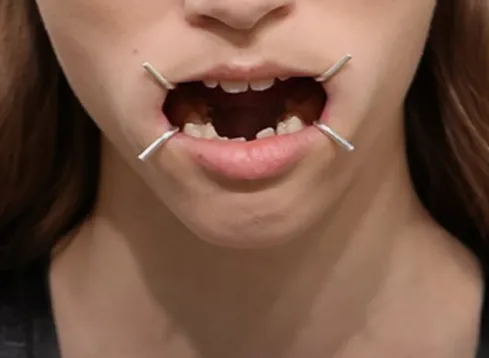 Close-up of a model’s mouth with four white stitch-like pins at its corners, echoing the Margiela four-stitch motif